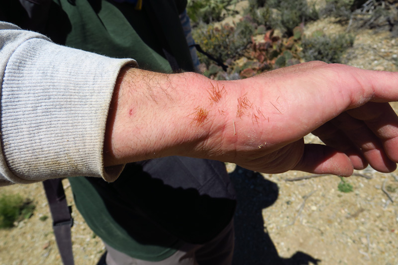 35-lots_of_cactus_needles_in_my_arm