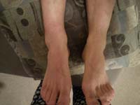 41-swollen_sprained_ankle_when_I_got_home-lots_of_ice_and_elevate_it