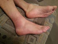 42-swollen_sprained_ankle_when_I_got_home-lots_of_ice_and_elevate_it