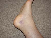 43-swollen_sprained_ankle_3_days_later