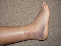 44-swollen_sprained_ankle_3_days_later