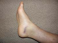 45-swollen_sprained_ankle_5_days_later