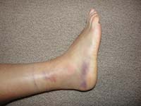 46-swollen_sprained_ankle_5_days_later