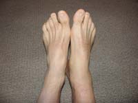 47-swollen_sprained_ankle_7_days_later