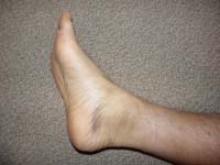 48-swollen_sprained_ankle_7_days_later