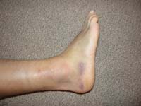 49-swollen_sprained_ankle_7_days_later-swelling_has_gone_down-use_brace_daily